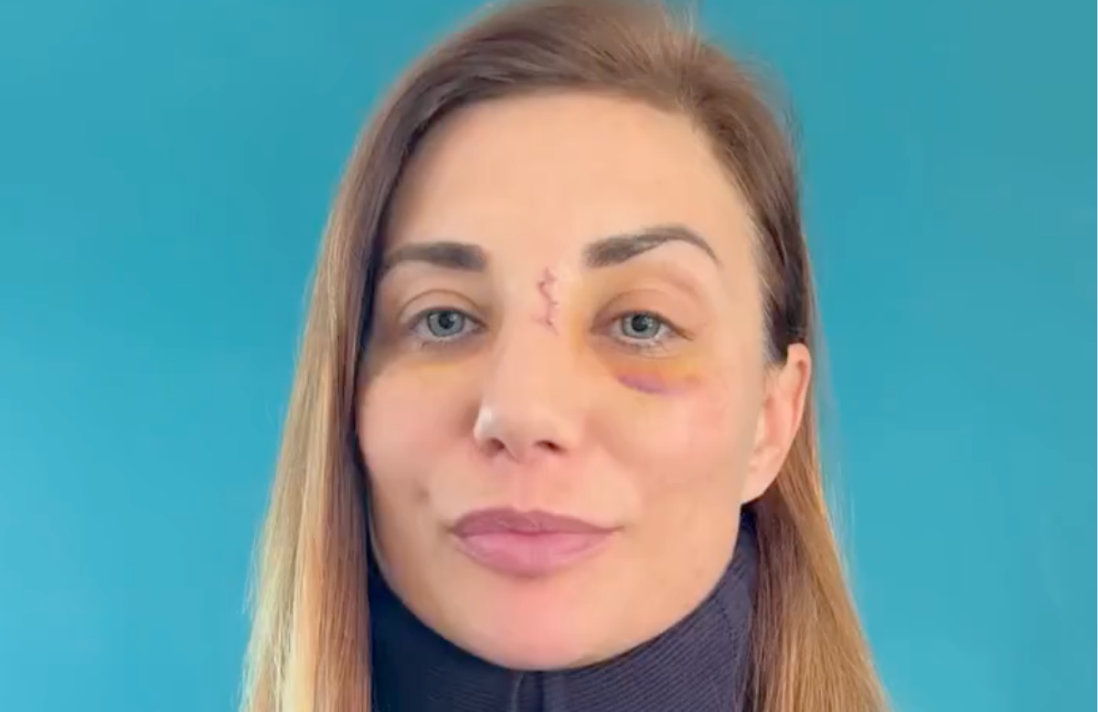 Ariane Brodier Défigurée après Agression Violente : Œil au Beurre Noir, Minerve et Chirurgie Imminente | Témoignage Exclusif